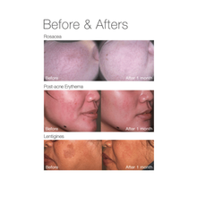 Load image into Gallery viewer, Pigmentation, Rosacea, Melasma, Broken Capillaries treatment + Full Face Laser Rejuvenation
