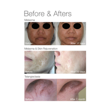 Load image into Gallery viewer, Pigmentation, Rosacea, Melasma, Broken Capillaries treatment + Full Face Laser Rejuvenation
